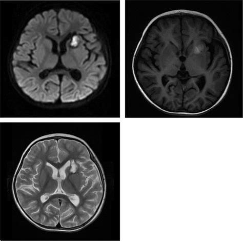 Hemorrhagic stroke at left basal ganglia seen on cerebral magnetic... | Download Scientific Diagram