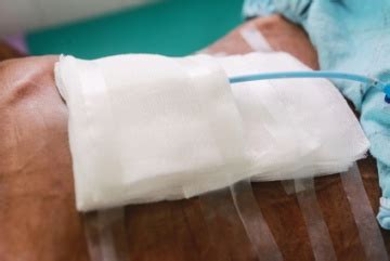 Wound Exudate Assessment and Management Strategies | WoundSource