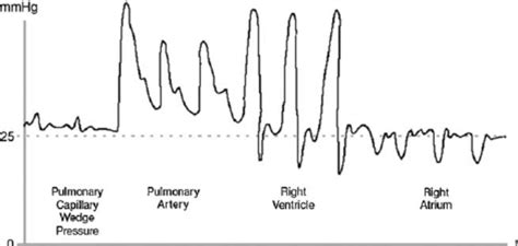 Pulmonary Artery Wedge Pressure