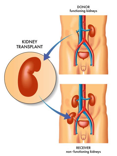 Kidney Transplant - Harvard Health