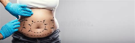 Liposuction Abdominoplasty Plastic Surgery Stock Image - Image of ...