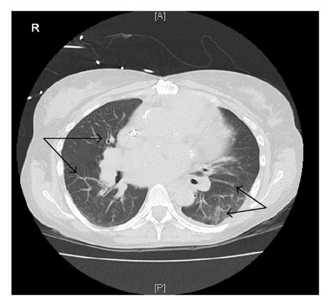 CT scan of the chest showing bilateral lungs ground-glass and... | Download Scientific Diagram