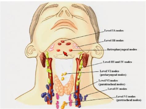 Cervical Cancer Lymph Nodes