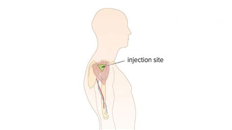 Three Intramuscular Injection Sites