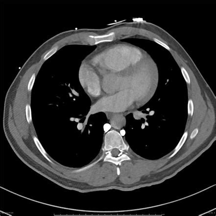 Azygos vein | Radiology Reference Article | Radiopaedia.org