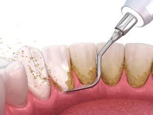 Calculus Bridge or Tartar? Its Cause, Symptoms and How to Get Rid of it!