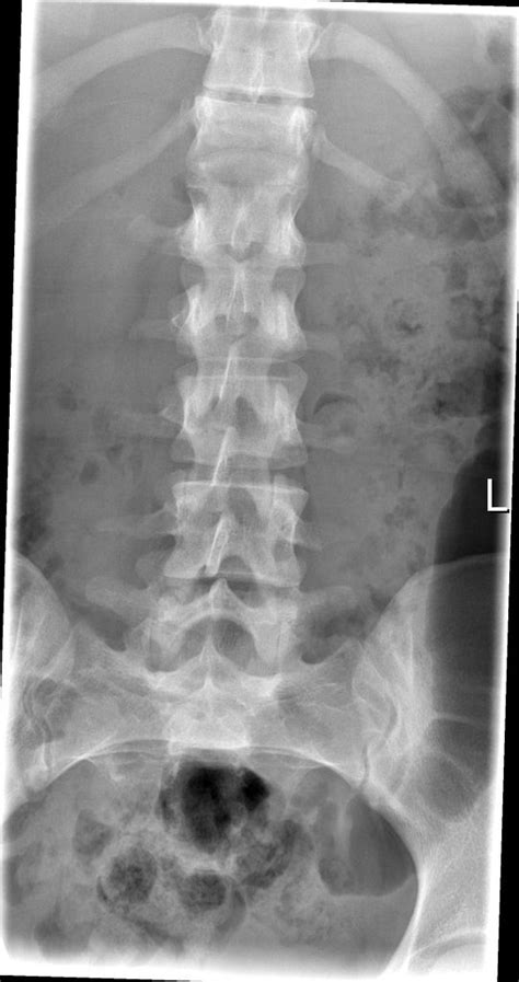 Chance fracture | Radiology Case | Radiopaedia.org | Radiology, Fracture, Case