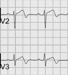 Wellens Syndrome | Syndrome, Medication management, Medical