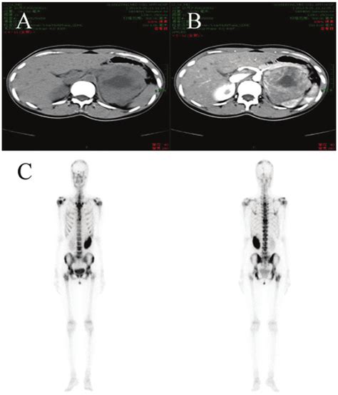 (A and B) Computed tomography scans of the abdomen and pelvis showing a... | Download Scientific ...