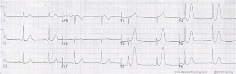 De Winter ST/T-Waves - ECG Medical Training