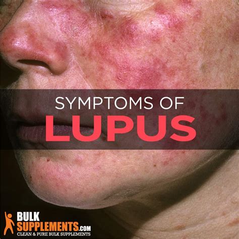 What is Lupus: Signs, Causes, Symptoms & Treatment