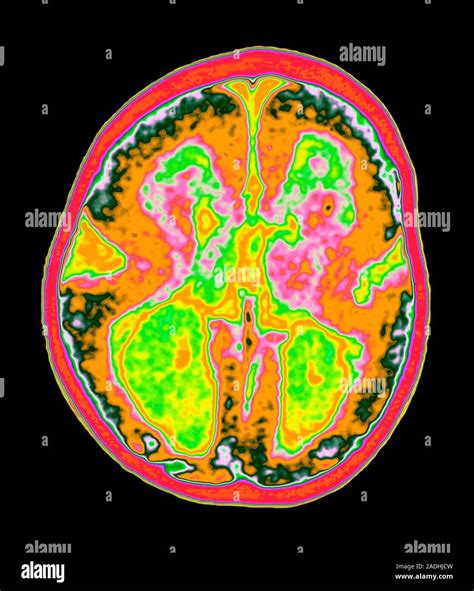 Lissencephaly Symptoms