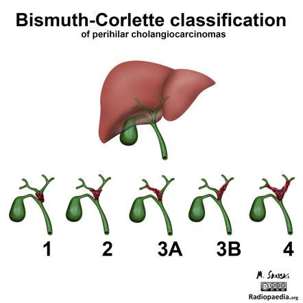 Bismuth-Corlette classification | Radiology Reference Article ...