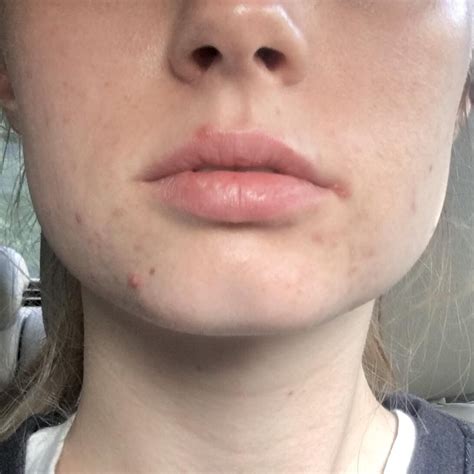 [SKIN CONCERN] (First time poster!) zits on lip line?! Post in comments ...