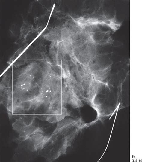 Multiple Clusters of Crushed Stone-like Calcifications on the Mammogram Produced by Malignant ...