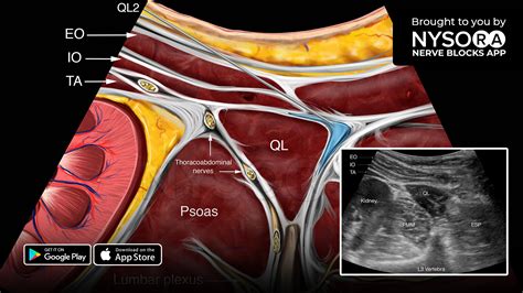 Quadratus Lumborum Block Ultrasound Nysora