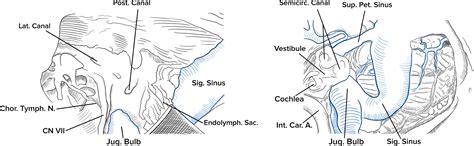 Jugular bulb and skull base pathologies: proposal for a novel classification system for jugular ...