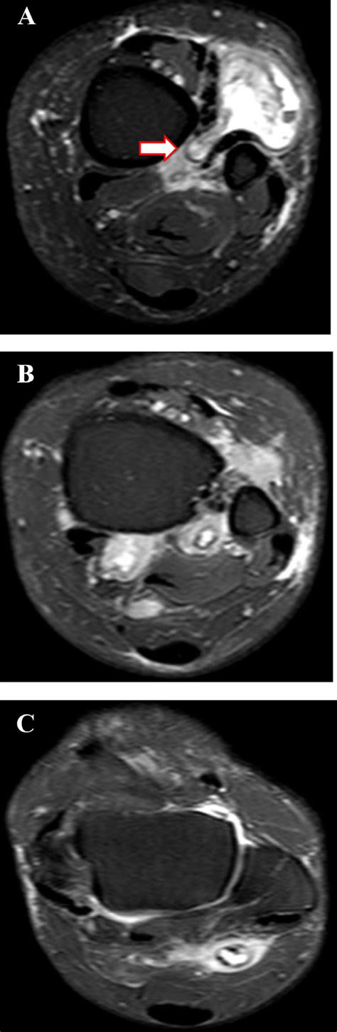 -MRI of the ankle, axial SPAIR-W images. (A) Image at the distal ...