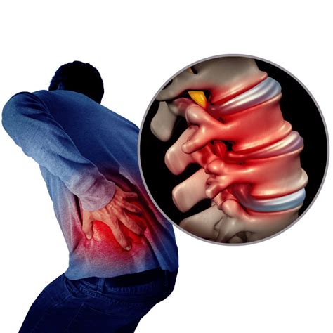 Bulging and Herniated Discs - Explained | Physical Health Care