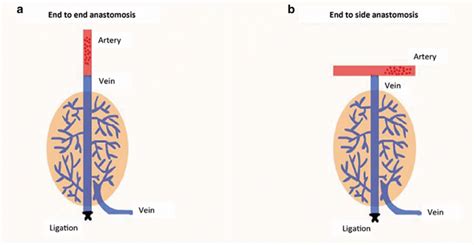 The illustration of end to end anastomosis and end to side anastomosis.... | Download Scientific ...