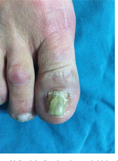 Complications of sodium hydroxide chemical matrixectomy: nail dystrophy, allodynia, hyperalgesia ...