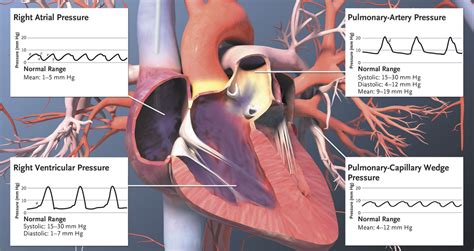 Pulmonary-Artery Catheterization | NEJM