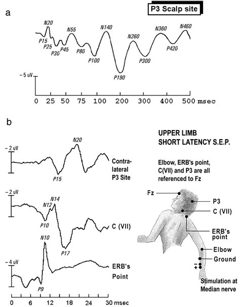 Diagram of somatosensory evoked potentials. (a) Theoretical example of... | Download Scientific ...