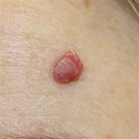 Angioma Removal Blood Blister Treatment | London Vein Centre