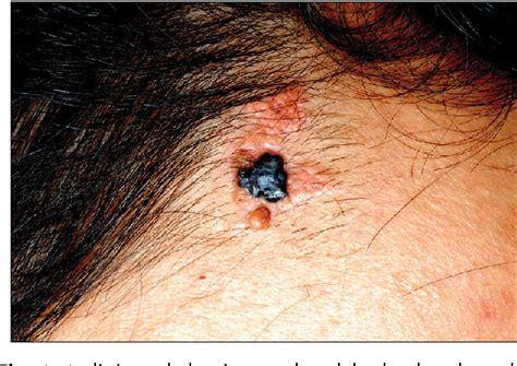 Figure 1 from Pigmented trichoblastoma arising from the nevus sebaceous ...