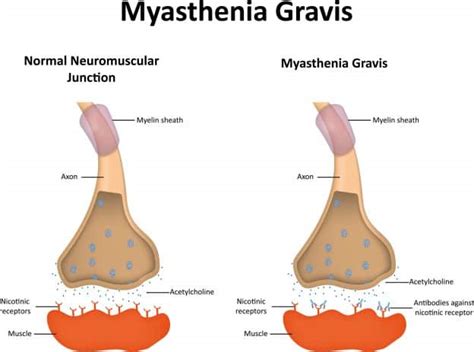 What is Myasthenia Gravis? – Causes, Symptoms, Treatment