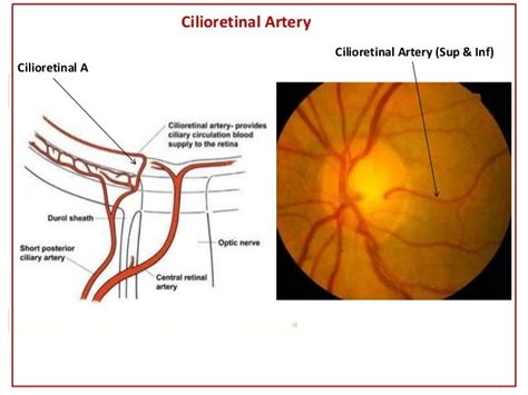 Ischemic of optic neuropathy, Optic Neuropathy (Ischemic), Eye Stroke…