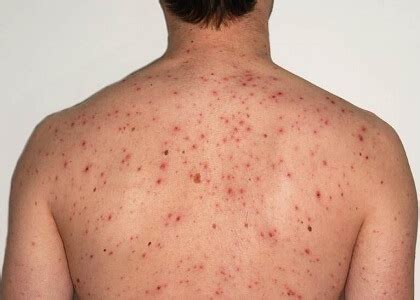 Arm & Shoulder Acne: Causes & Treatment