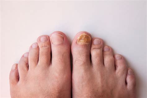 Toenail Fungus in East Setauket, Bronx & New York, NY | Paragon Podiatry