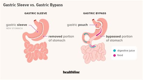 Gastric Sleeve vs. Gastric Bypass: Differences, Pros, Cons | Gastric ...