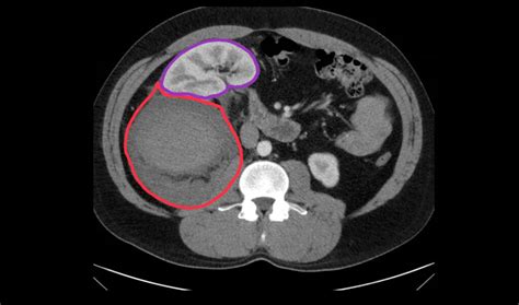 R Retroperitoneal Hematoma CT Annotated 2. JETem 2023 - JETem