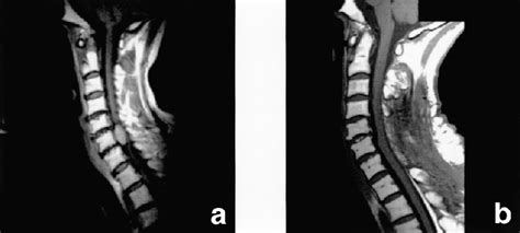 (a) MRI of the cervical spine of case 4 displays an enhanced tumor in... | Download Scientific ...