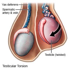 Testicular Torsion - What You Need to Know