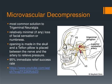 Trigeminal Neuralgia