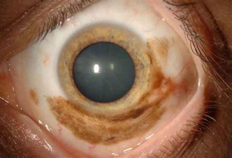 Ocular Melanoma Pictures – 27 Photos & Images / illnessee.com