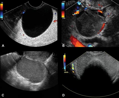 Using ultrasound to predict ovarian cancer • healthcare-in-europe.com