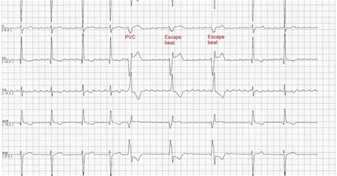 Ventricular Escape Beat ECG