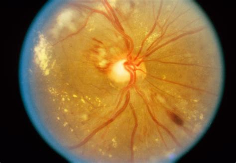 Hypertensive Retinopathy - Eye Disorders - MSD Manual Professional Edition