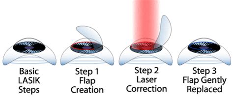 Laser & Lasik Eye Surgery Guide - How It Works, Cost, & Risks - Find ...