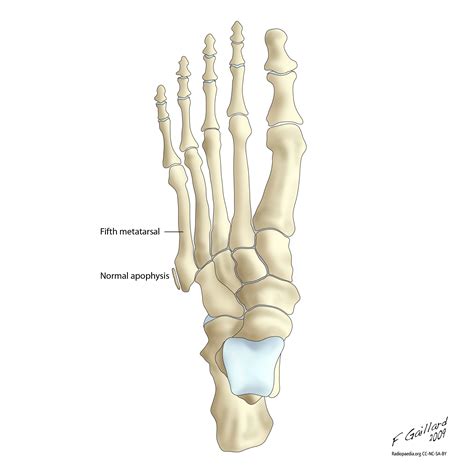 Metatarsal bones; Metatarsals