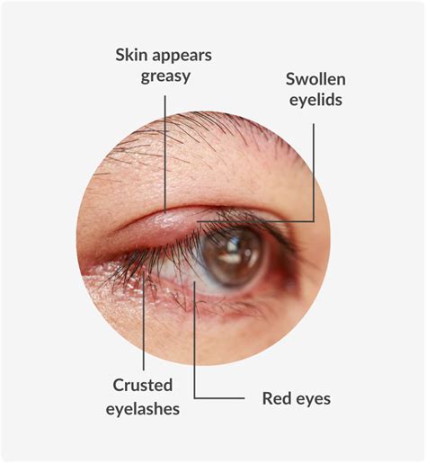 Blepharitis | Symptoms, Causes and Possible Treatments | SmartBuyGlasses UK