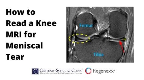 How To Read A Knee MRI For Meniscal Tear - Centeno-Schultz