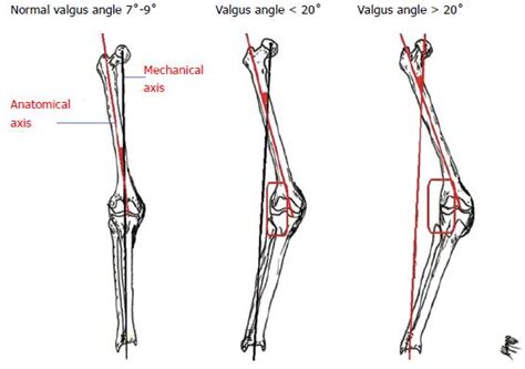 Current surgical strategies for total arthroplasty in valgus knee