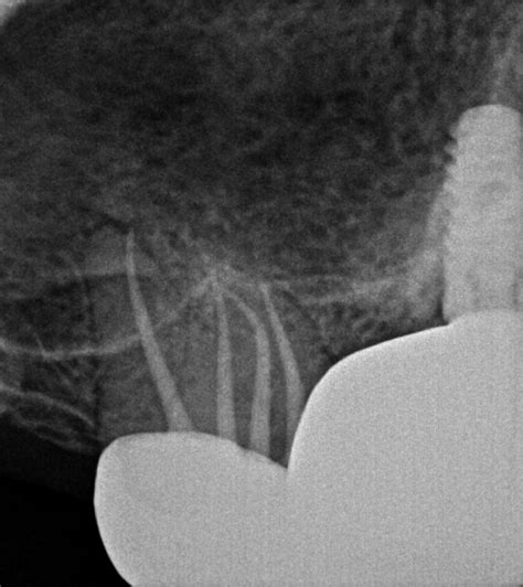 Maxillary Second Molar Root Canal - Rich Dawson DMD