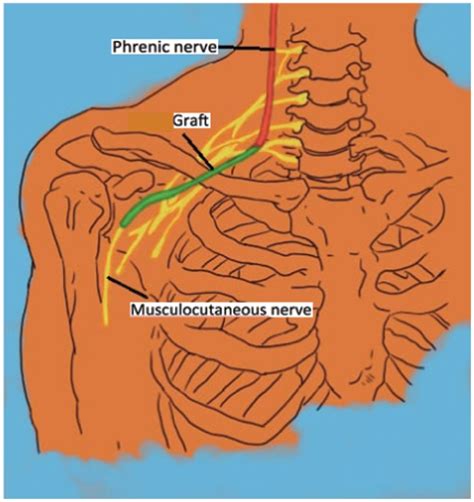 Phrenic nerve to musculocutaneous nerve. | Download Scientific Diagram