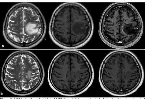 Figure 2 from THE MRI FEATURES IN DIAGNOSING TUMEFACTIVE DEMYELINATING LESION | Semantic Scholar